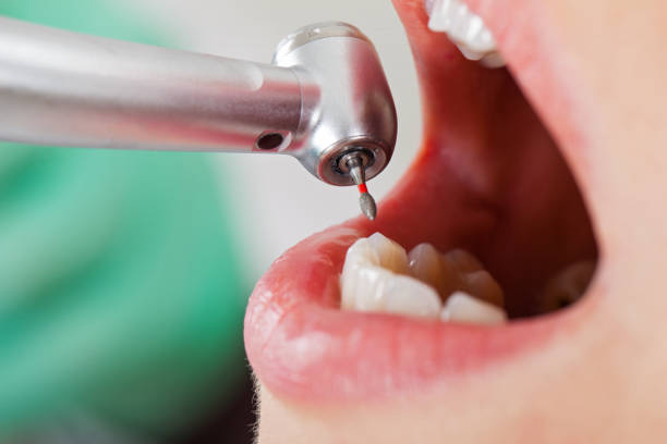 Best Emergency Wisdom Teeth Removal in Cohasset, MN